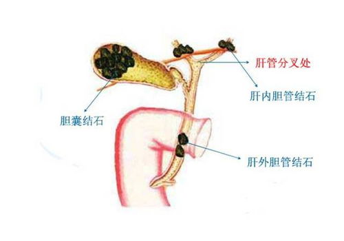 胆结石病人游戏攻略(适合胆结石病人的运动)